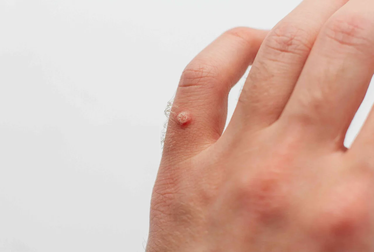 hpv-infections.jpg