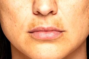 کدام غذاها باعث لک صورت می شوند؟