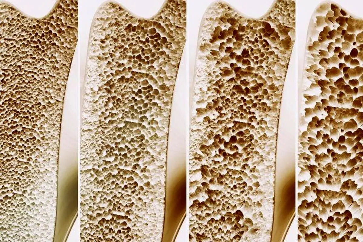 کشف نقش شگفت‌انگیز ویتامین کا در جلوگیری از پوکی استخوان 