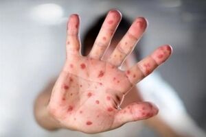 شیوع سرخک منجر به مسمومیت خطرناک ویتامین A می‌شود