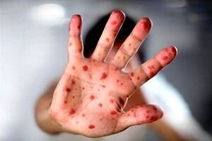 شیوع سرخک منجر به مسمومیت خطرناک ویتامین A می‌شود