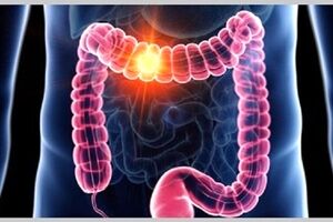 پیشگیری از سرطان روده بزرگ با راهکاری ساده 