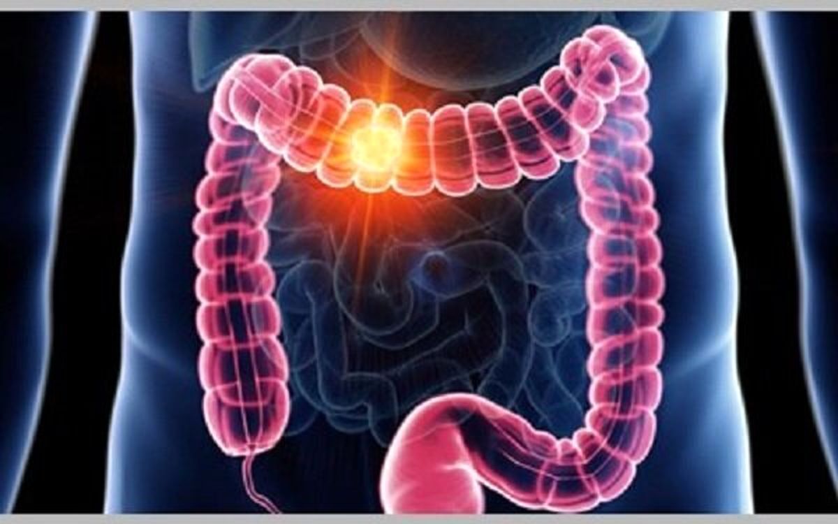 پیشگیری از سرطان روده بزرگ با راهکاری ساده 