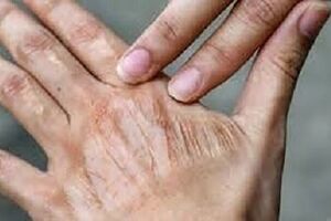 اقدام ساده برای رفع خشکی پوست