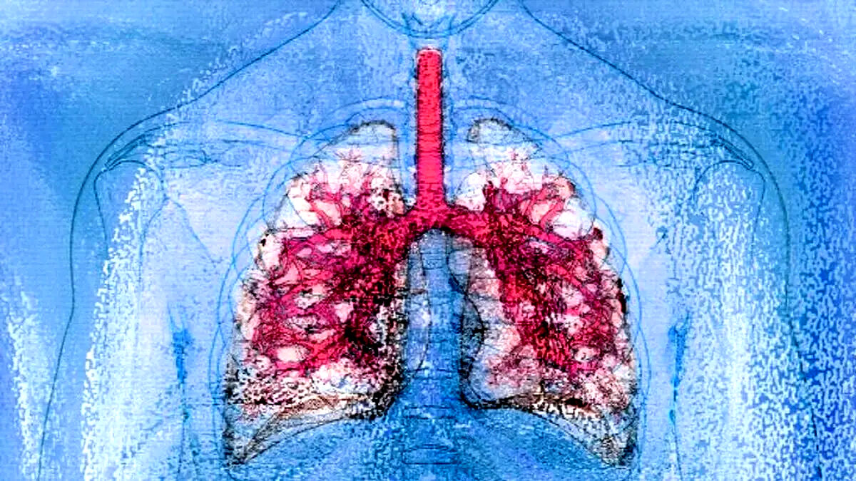 نخستین پیوند همزمان ریه و کبد میان دو فرد HIV مثبت 