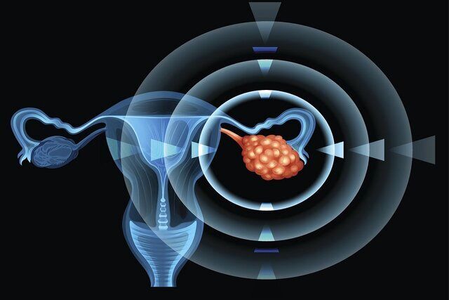 تمرینات هوازی، یاری‌گر بدن زنان در برابر «سندرم تخمدان پلی‌کیستیک»