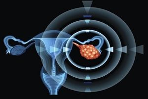 تمرینات هوازی، یاری‌گر بدن زنان در برابر «سندرم تخمدان پلی‌کیستیک»