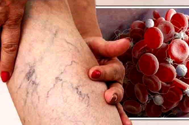 آیا لخته شدن خون در پا خطرناک است؟