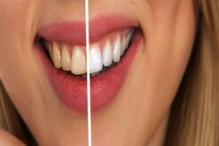 عوارض بلیچینگ دندان چیست و چگونه از آن پیشگیری کنیم؟