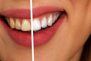 عوارض بلیچینگ دندان چیست و چگونه از آن پیشگیری کنیم؟