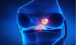 مقایسه دو روش ترمیم مینیسک زانو در پژوهش محققان ایرانی 