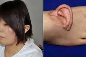 گوش برای اولین بار به پا پیوند زده شد 