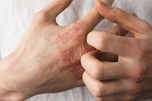 توصیه‌هایی درباره یک عارضه پوستیِ شایع