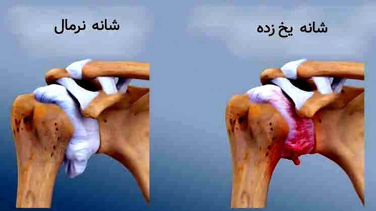 آیا سرما باعث درد شانه می‌شود؟/ شانه یخ‌زده چیست؟/ این درد درمانی دارد؟