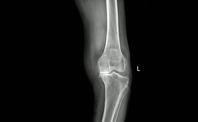 تغییر «شیوۀ راه رفتن» می‌تواند پیشرفت «بیماری آرتروز» را به تعویق بیاندازد 