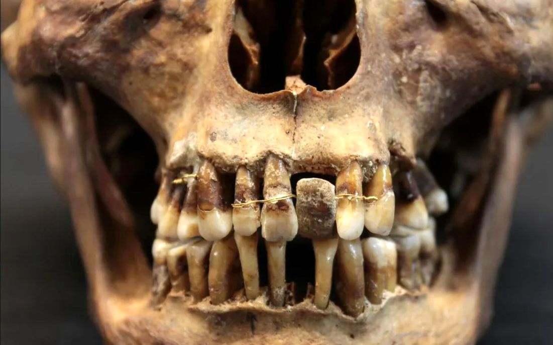 زنی که ۴۰۰ سال قبل دندان‌هایش را «سیم‌کشی» کرده بود 