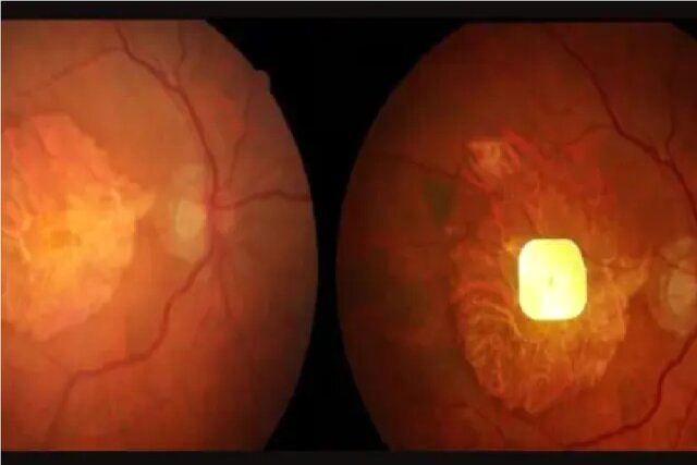 نابینایان با این ایمپلنت دوباره می‌توانند بخوانند