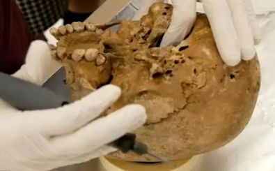 تشخیص یک بیماری ژنتیکی نادر در «اسکلت 12 هزارساله»