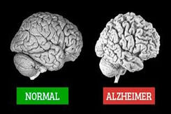آلزایمر چیست، نشانه هایش کدام است و چه کنیم مبتلا نشویم؟ 
