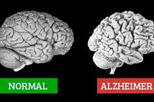 آلزایمر چیست، نشانه هایش کدام است و چه کنیم مبتلا نشویم؟ 