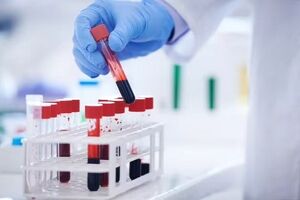 تشخیص خستگی مزمن با یک آزمایش خون پیشرفته