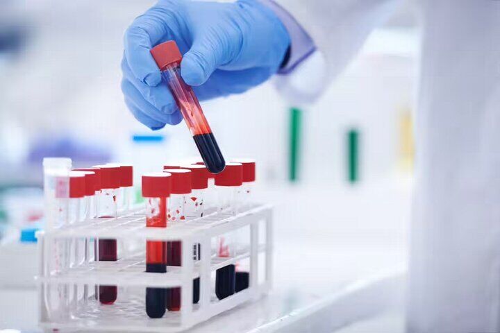تشخیص خستگی مزمن با یک آزمایش خون پیشرفته