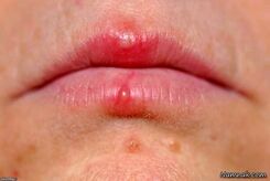 اشتباه مهلک در تشخیص آفت و تب‌خال؛ کدام‌یک مسری و خطرناک است؟