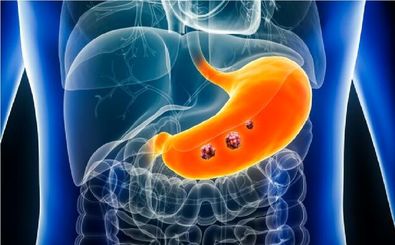 سبک زندگی و عادات غذایی مناسب برای پیشگیری از «سرطان معده»