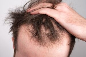 ماینوکسیدیل خوراکی برای ریزش موی مردانه موثرتر است
