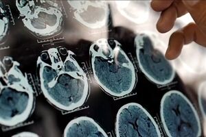 هر ۷ دقیقه یک ایرانی به این بیماری مبتلا می‌شود