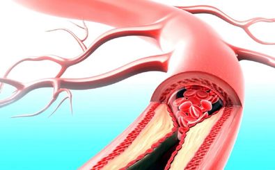دارویی که همزمان با بیماری قلبی و دیابت مقابله می‌کند