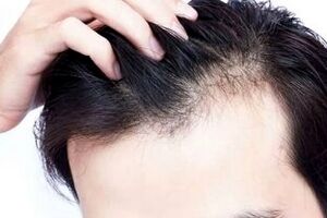 مهمترین دلایل ریزش موهای سر